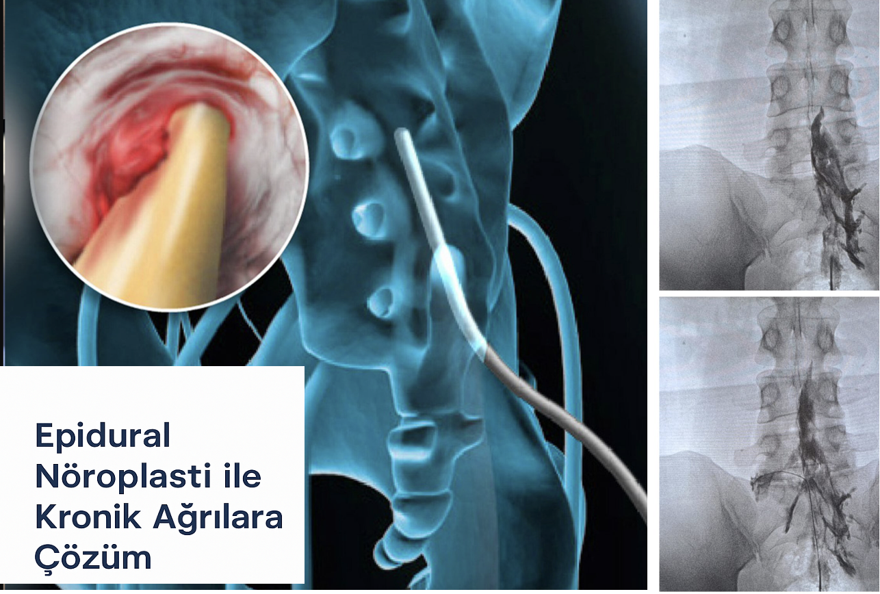 Epidural Nöroplasti